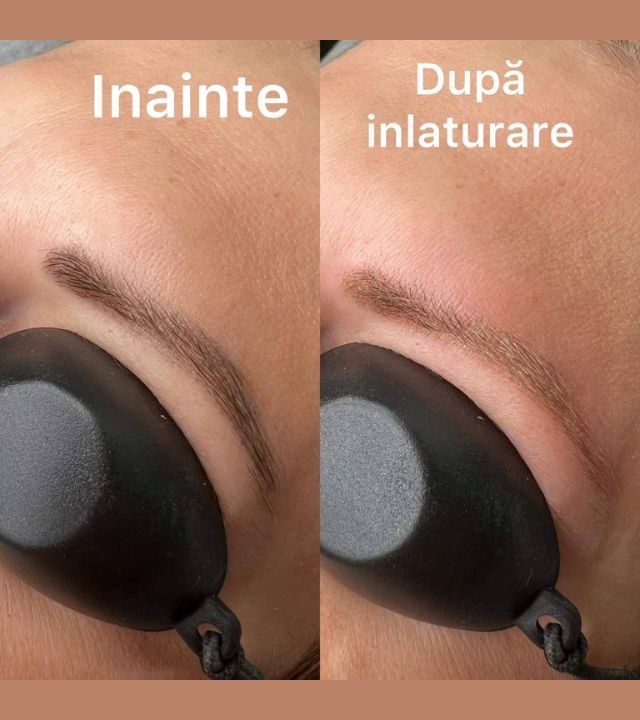 Îndepărtarea tatuajului cu laser2